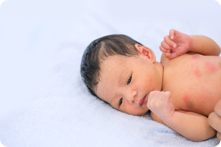 Kenali, 7 Jenis Ruam pada Bayi dan Cara Mengatasinya - Bebe Roosie ...